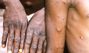 Khác biệt giữa đậu mùa khỉ và COVID-19