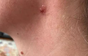 Nốt ruồi tự nhiên đổi màu sau một đêm, đi khám phát hiện bị ung thư 