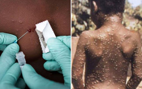 Có nên tiêm vaccine phòng bệnh đậu mùa khỉ ngay từ bây giờ?