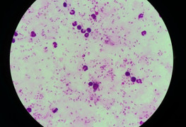 Hai người Việt từ châu Phi về bị sốt rét ác tính