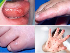 Trẻ mắc bệnh tay chân miệng biến chứng nặng sẽ có những dấu hiệu gì?