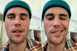 Justin Bieber bị liệt nửa mặt do hội chứng hiếm gặp