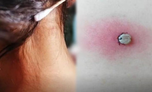 Người mẹ rùng mình khi biết 'nốt ruồi lạ' trên người con là 'quái vật' hút máu