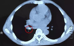 Nam thanh niên xuất huyết não sau khi đi bơi