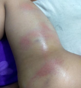 Bình Dương: Bé gái 4 tuổi nghi bị cô giáo đánh bầm tím cả cơ thể