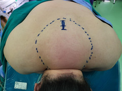 Tưởng béo, đi khám mới biết mắc bệnh hiếm gặp