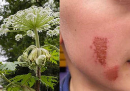 Cây 'sứ giả địa ngục' khiến bé trai bỏng mặt chỉ sau cú chạm nhẹ