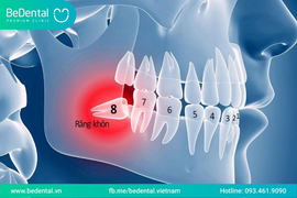 Nhổ răng khôn và răng cấm không đau tại Nha khoa thẩm mỹ BeDental