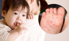 Phân biệt mụn mọc do thuỷ đậu, ghẻ ngứa với tay chân miệng 
