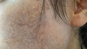 Mặt 'cháy đen' vì lăn kim, lột da bằng hóa chất vô tội vạ