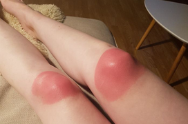 Hàng loạt vết tích cháy nắng hài không đỡ được vì lỡ coi thường cái nắng hè