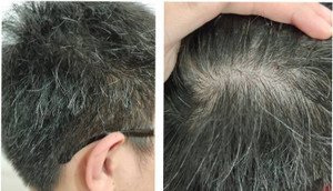 Mới ngoài 20 tuổi tóc đã bạc trắng, bác sĩ chỉ ra thủ phạm 