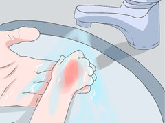 Trẻ nguy kịch do chữa bỏng sai: Bác sĩ gợi ý cách sơ cứu chuẩn nhất 