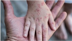 Bệnh đậu mùa khỉ lây truyền từ người sang người thế nào?