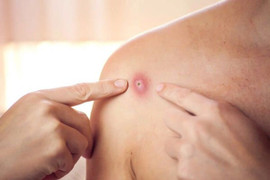 Ai nguy cơ bị biến chứng nặng khi mắc bệnh đậu mùa khỉ?