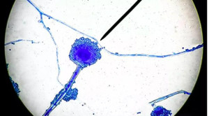 'Nấm đen' khiến người bệnh hoại tử xương, tử vong có gì bí ẩn?