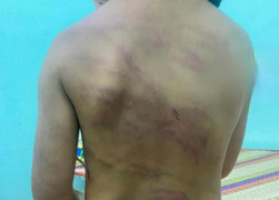 Bé gái ở Bình Phước có nhiều vết thương trên người, nghi bị bạo hành