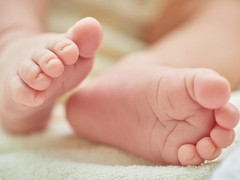 Cảnh báo: Trẻ có thể mất ngón chân vì sợi tóc rụng