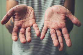 Những trường hợp cần theo dõi chặt khi mắc đậu mùa khỉ