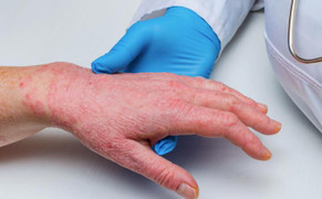 Mỹ: Bệnh đậu mùa khỉ lây lan, New York ban bố tình trạng khẩn cấp