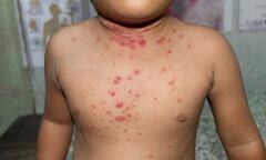 Mỹ lo thiếu vaccine ngừa virus đậu mùa khỉ
