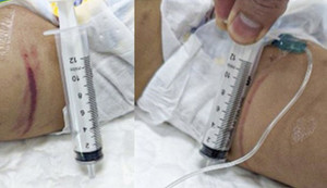 Sức khỏe bé gái 18 tháng tuổi nghi bị bạo hành tại Hà Nội giờ thế nào?