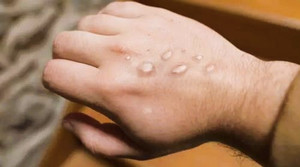 Lo dịch chồng dịch, Thủ tướng yêu cầu phòng chống đậu mùa khỉ ‘cao hơn một mức’