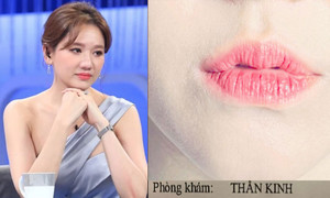 Sao Việt 3/8: Hari Won bị liệt cơ mặt bên trái