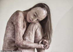 Hành trình tìm lại sự ‘sống’ của cựu hoa hậu bị bỏng gần hết cơ thể sau đám cháy