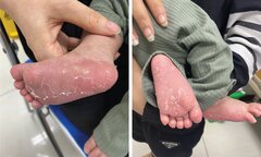 Trẻ 46 ngày tuổi bị giang mai 