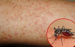 Nhiều ca tử vong do mắc sốt xuất huyết và tay chân miệng ở Bình Dương