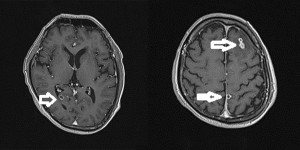 Kinh hãi sán làm tổ trong não người phụ nữ