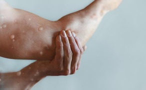 Việt Nam nghiên cứu sản xuất thuốc chữa bệnh đậu mùa khỉ