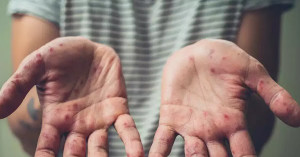 Số người mắc đậu mùa khỉ ở Mỹ vượt 10.000 ca, cao nhất thế giới