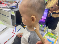 Bé 1 tuổi liệt mặt do nằm quạt