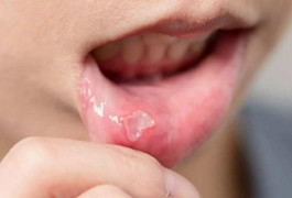 Dấu hiệu này trên lưỡi chứng tỏ bạn thiếu vitamin B12