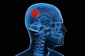 Đau đầu dữ dội, nam thanh niên Hà Nội đi khám mới biết có u khổng lồ trong sọ 