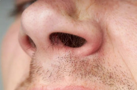 Người đàn ông bị hoại tử mũi vì mắc đậu mùa khỉ