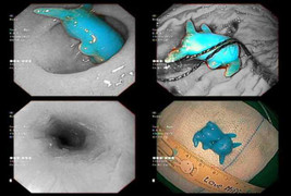 Pikachu đồ chơi kẹt trong thực quản bé 6 tuổi