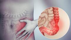 Viêm loét đại tràng và nỗi lo biến chứng