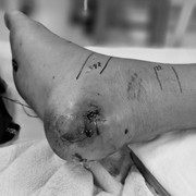 Tự ý đắp lá chữa rắn cắn, bé trai nhiễm trùng nặng