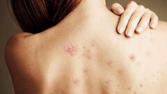 Suýt tử vong sau khi trị mụn ở lưng