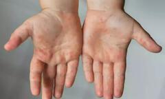 Phân biệt bệnh đậu mùa khỉ và cúm cà chua 