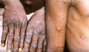 Mỹ xác nhận ca tử vong đầu tiên do đậu mùa khỉ