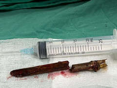 Phú Thọ: Cứu sống nam thanh niên bị tre đâm xuyên cổ