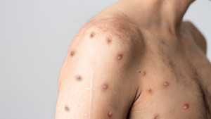 Anh phát hiện biến chủng đậu mùa khỉ mới 