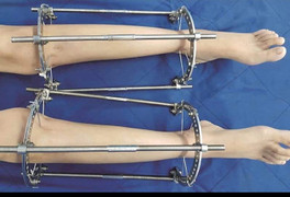 Câu chuyện của những cô gái vỡ mộng chân dài