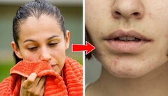 Vị trí mụn trứng cá tiết lộ thói quen, lối sống của bạn
