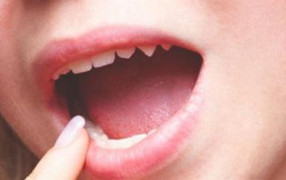 Tưởng nhiệt miệng, đi khám phát hiện ung thư lưỡi giai đoạn cuối