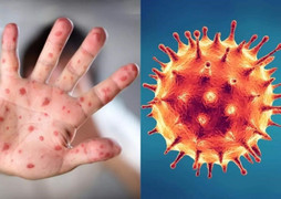 Ca đậu mùa khỉ đầu tiên tại Việt Nam khởi phát bệnh khi du lịch Dubai